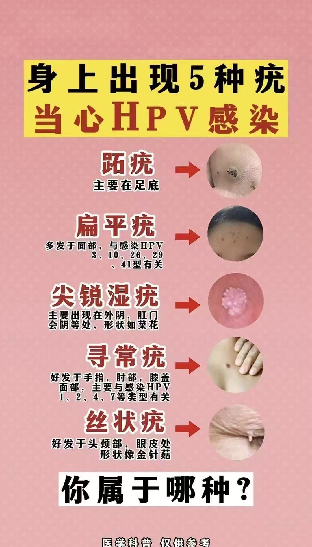 尖锐湿疣怎么治疗才能根治_(尖锐湿疣怎么治疗才能根治口腔) 尖锐湿疣怎么治疗才能根治_(尖锐湿疣怎么治疗才能根治口腔)