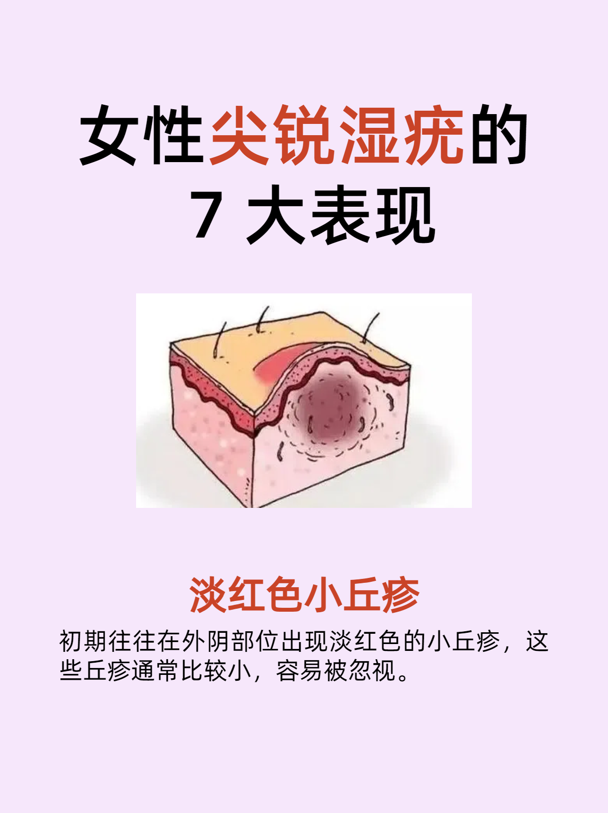 尖锐湿疣初期症状图片_(尖锐湿疣初期症状图片口腔) 尖锐湿疣初期症状图片_(尖锐湿疣初期症状图片口腔)